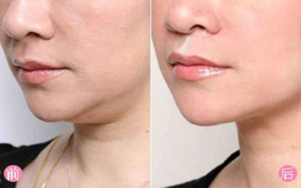 杭州消除額頭紋比較好的整形醫(yī)院排名公布，看看2023年前10位靠譜名單！