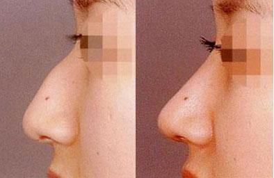 江陰溶脂針瘦背哪家整形美容醫(yī)院更受推薦？2023年江陰比較好的溶脂針瘦背醫(yī)院排行榜揭曉！前10強(qiáng)名單一覽！