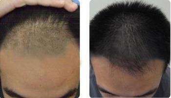 鎮(zhèn)江哪家醫(yī)院效果好？2023年玻尿酸填充額頭美容醫(yī)院排名全新預(yù)測(cè)！