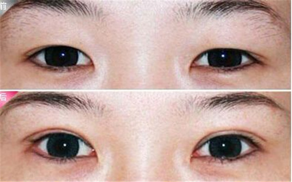 杭州哪家整形醫(yī)院效果好，專業(yè)解決祛痘坑痘印問題，2023很受歡迎的前十家！