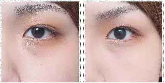 2023德州眼底紋玻尿酸注射整形美院排行榜，你知道嗎？