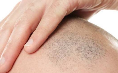 2023三亞微晶磨削點(diǎn)痣醫(yī)療美容醫(yī)院推薦，求穩(wěn)定效果好的！