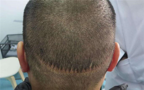 重慶十家熱門醫(yī)院推薦！2023重慶超聲去除黑眼圈美容醫(yī)院精選十強(qiáng)深度評判！