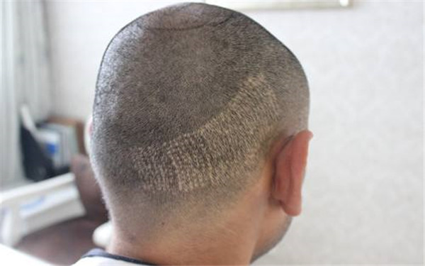 黃石市木偶紋淡化技術(shù)的醫(yī)療整形醫(yī)院盤點(diǎn)！2023年黃石療效比較好的木偶紋淡化醫(yī)院前10強(qiáng)大揭秘！