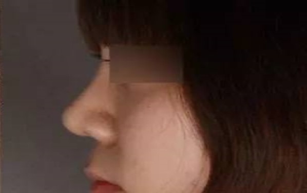 重慶哪家整形醫(yī)院祛黑眼圈效果靠譜？2023年重慶祛黑眼圈醫(yī)療機構(gòu)排名前十值得信賴嗎？