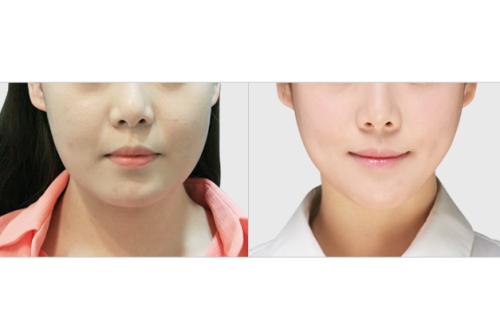 2023杭州祛生長紋醫(yī)院排行榜公布！這些整形專家經(jīng)驗豐富的醫(yī)院排名前十！