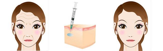 2023年溫州哪家整形醫(yī)院效果比較好？去生長紋，熱拉提推薦！