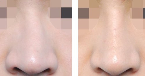 湖南哪家醫(yī)院比較好做光乳化手術(shù)祛眼袋？湖南2023年全國(guó)十佳整形醫(yī)院眼袋療效！推薦！