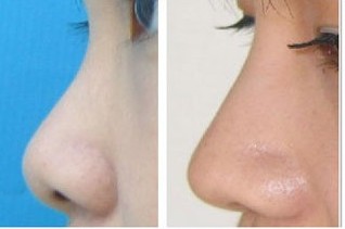 2023年海南哪家整形醫(yī)院口碑好？填充淚溝效果受網(wǎng)友推薦的醫(yī)院有哪些？