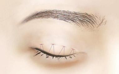 2023年武漢專業(yè)祛川字紋醫(yī)院排行榜出爐，TOP10強(qiáng)名單公布！