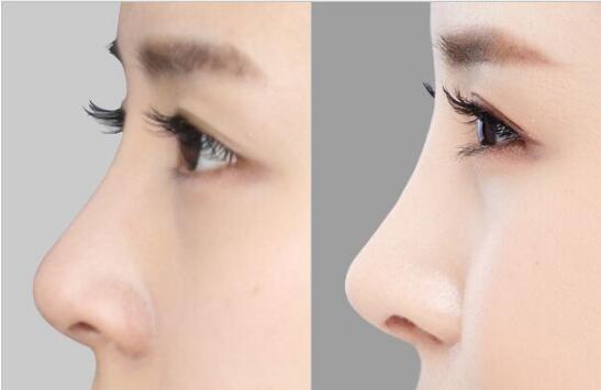 西安哪家醫(yī)院的手術(shù)祛除眉間紋效果比較好？2023西安一流美容醫(yī)院推薦top10！