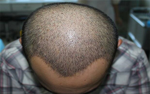 無錫哪家醫(yī)院的假體太陽穴整形效果比較好？2023年排名前10位的醫(yī)院值得選擇！