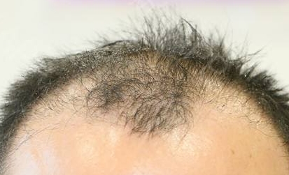 南寧有哪些給人注射木偶紋的醫(yī)療美容醫(yī)院效果好？2023年南寧木偶紋注射整形醫(yī)院排行榜前10強評選揭曉！