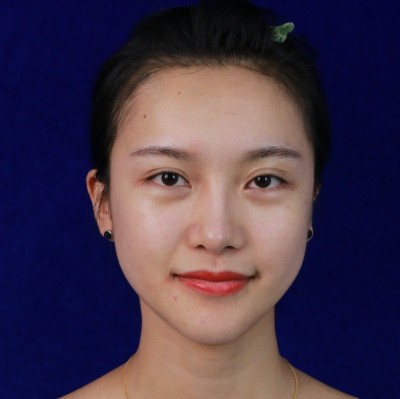 眼綜合術(shù)前VS術(shù)后，自然大眼睛值得稱贊！