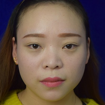 術(shù)前矮低平，術(shù)后高挺翹~肋軟骨隆鼻效果好的不得了！