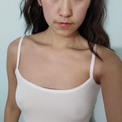 廣州韓妃整形美容醫(yī)院復(fù)合豐胸（假體+自體脂肪）100天效果反饋