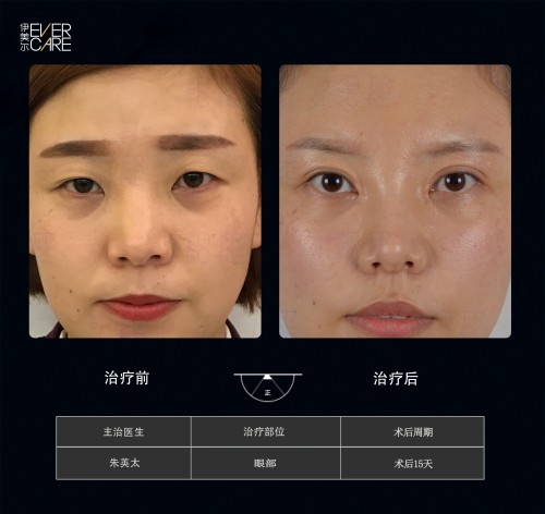 阿爾法9°美眼，打開視界，美無止境