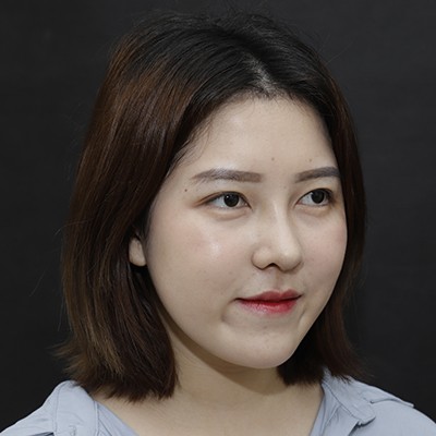 廣州美恩半肋鼻手術(shù)恢復(fù)效果反饋，主任親自操刀的效果就是贊！