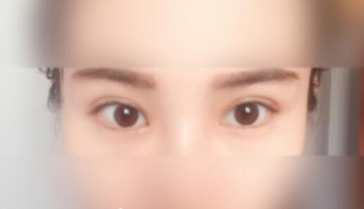 延吉金光善整形雙眼皮一個月效果分享，有對比圖