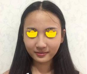 深圳鵬愛(ài)做隆鼻手術(shù)前效果