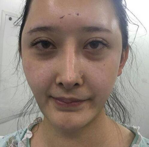 深圳陽光全臉填充術(shù)前術(shù)后對比，說年輕十歲不過分吧