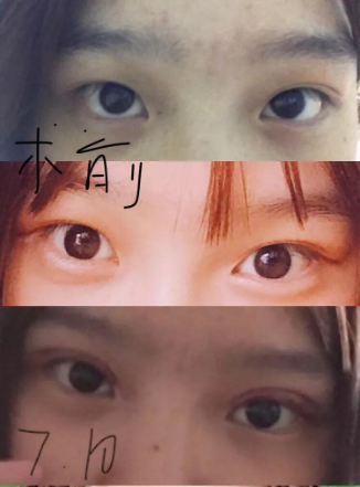 做雙眼皮案例，濟(jì)南坤如瑪麗崔金珍雙眼皮案例圖片