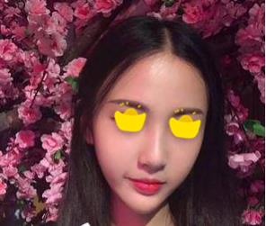 深圳鵬愛(ài)做隆鼻手術(shù)一個(gè)月效果