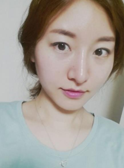 原來駝峰鼻整完這么好看，我再也不是丑美丑美的了