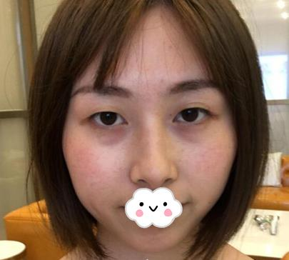 武漢亞太整形雙眼皮術(shù)后一個月效果分享