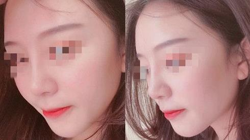 耳軟骨隆鼻術后三個月，我有了韓佳人同款美鼻