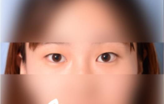 延吉金光善整形雙眼皮一個月效果分享，有對比圖