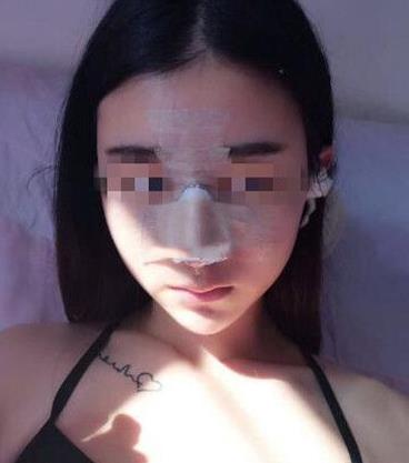 石家莊諾萬整形姚華榮硅膠隆鼻案例分享術(shù)后兩天效果
