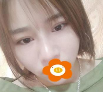 據(jù)說(shuō)杭州薇琳隆鼻后效果很自然，有案例嗎