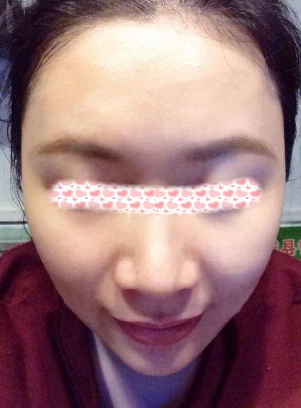 西安米蘭柏羽整形手術(shù)縮鼻翼案例分享術(shù)后兩個(gè)月效果