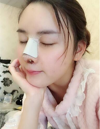北京藝星整形硅膠假體隆鼻術(shù)后第二天側(cè)面效果