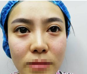 親身經(jīng)驗，重慶星范整形的超體隆鼻真的很自然