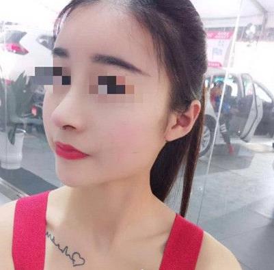 石家莊諾萬整形姚華榮硅膠隆鼻案例分享術(shù)前效果后三個(gè)月效果