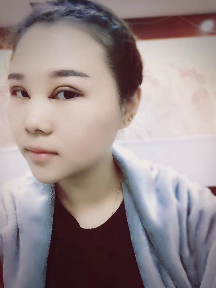 腫眼泡應(yīng)該做哪種雙眼皮？汕頭曙光雙眼皮三個(gè)月效果分享