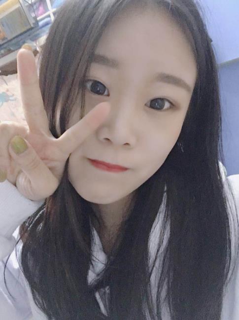 石家莊諾萬整形肋軟骨隆鼻案例術(shù)后一個(gè)月效果