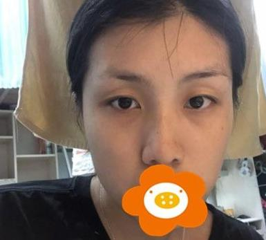 救命，周杰群做的耳軟骨隆鼻恢復(fù)后鼻背線條也太好看了吧