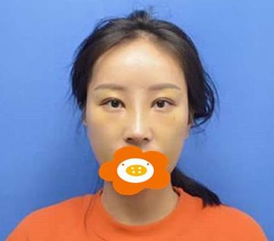 鄭州禾麗做肋軟骨隆鼻術(shù)后一個(gè)月效果