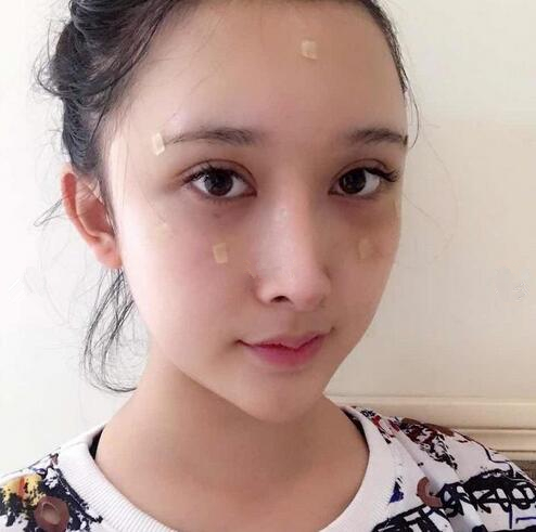 深圳陽光全臉填充術(shù)后即刻效果 深圳陽光全臉填充術(shù)后即刻效果