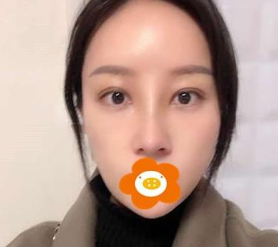 萬(wàn)萬(wàn)沒(méi)想到在鄭州禾麗做的肋軟骨隆鼻效果居然是這樣的