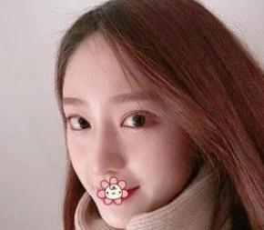 北京彤美耳軟骨隆鼻案例分享術(shù)后一個月效果