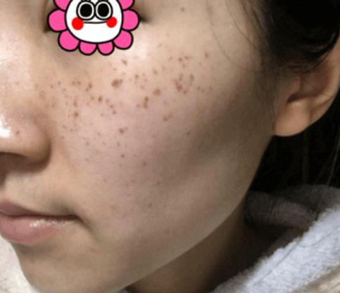 困惱我多年的斑，沒想到在溫州韓美三千塊錢就去掉了