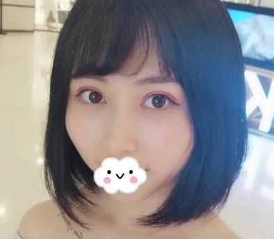 武漢亞太整形雙眼皮案例術(shù)后兩個月效果