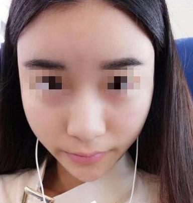 石家莊諾萬整形姚華榮硅膠隆鼻案例分享術(shù)前效果