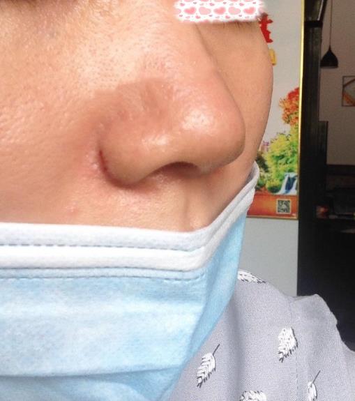 西安米蘭柏羽整形手術(shù)縮鼻翼案例分享術(shù)后一個(gè)月效果