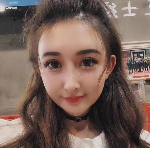 深圳陽光全臉填充術(shù)前術(shù)后對比，說年輕十歲不過分吧