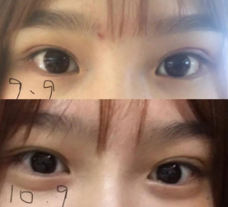 做雙眼皮案例，濟(jì)南坤如瑪麗崔金珍雙眼皮案例圖片